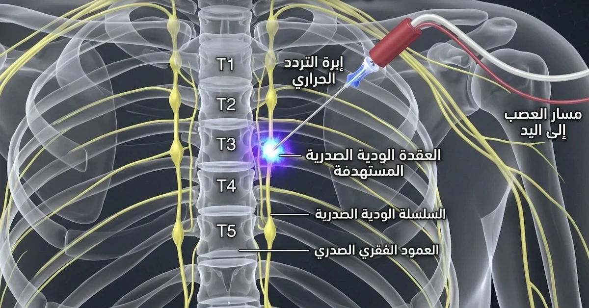 التردد الحراري لعلاج تعرق اليدين